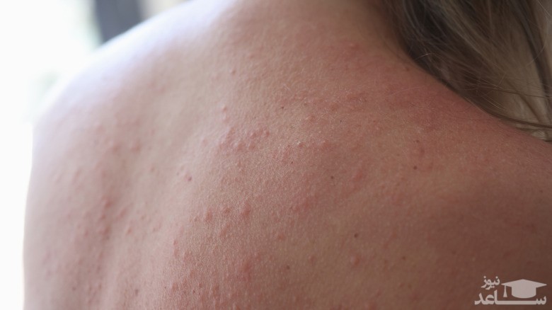 راش های پوستی