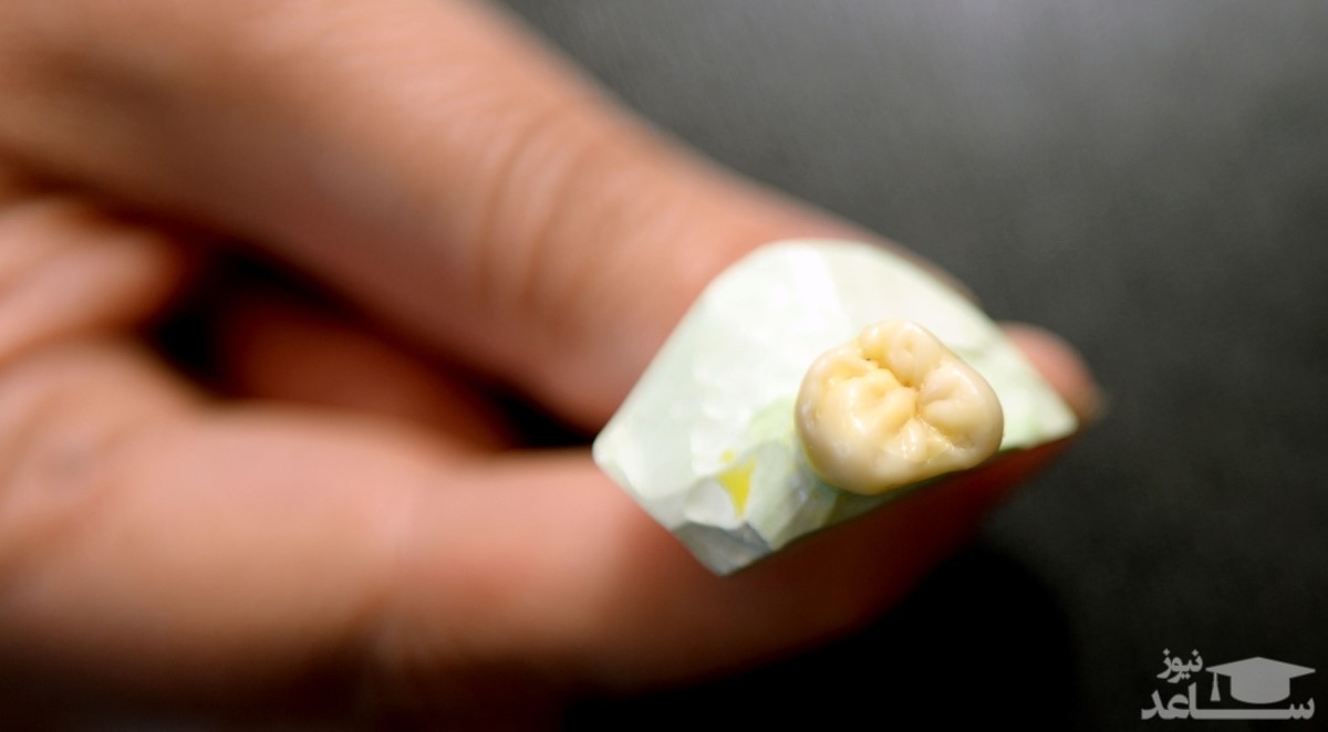هر آنچه در مورد افتادن روکش ایمپلنت دندان باید بدانید!