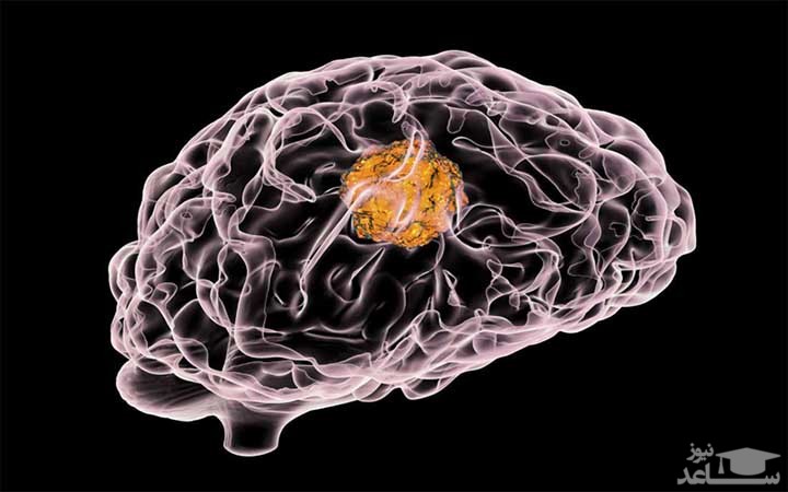 درمان تومورهای مغزی چیست؟