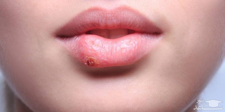 تبخال ؛ علائم، روشهای پیشگیری، درمانهای دارویی و خانگی