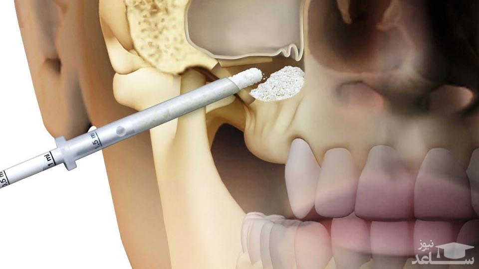 عمل سینوس لیفت دندان چیست؟