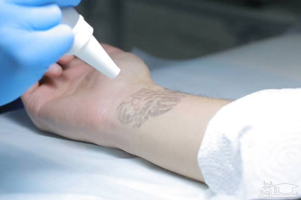 موثرترین روش برای پاک کردن تاتو