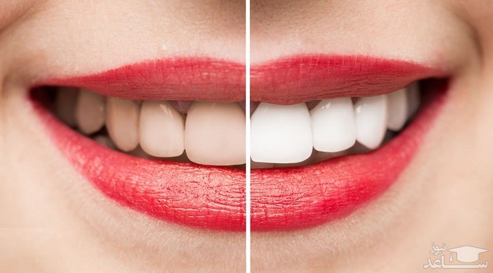 از بین بردن زردی دندان