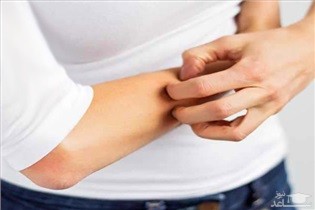 علت خارش بدن در زنان باردار و روش های درمان