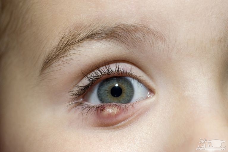 درمان شالازیون چشم با طب سنتی و گیاهان دارویی