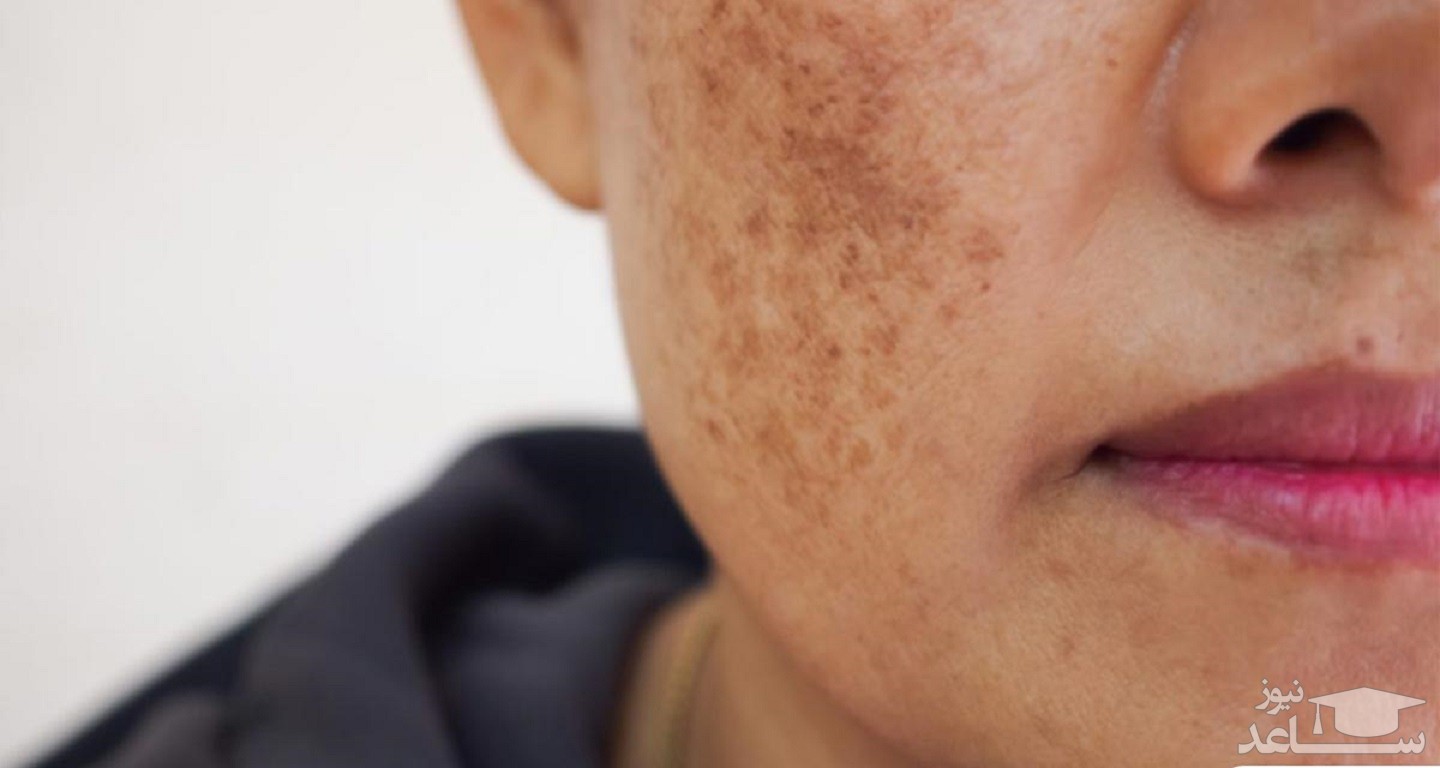 چگونه لکه های پوستی ناشی از کبد را تشخیص دهیم؟ + روش درمان آنها