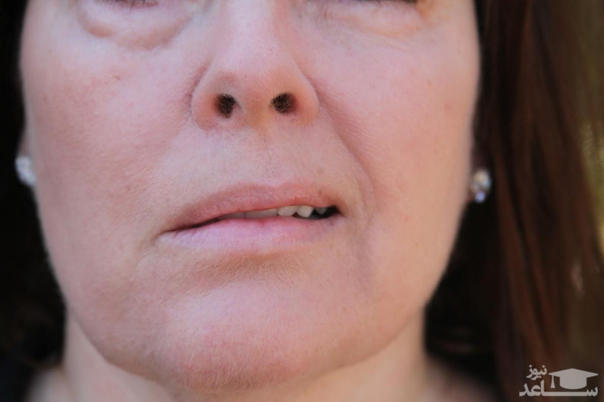 علت فلج بل و راههای درمان آن