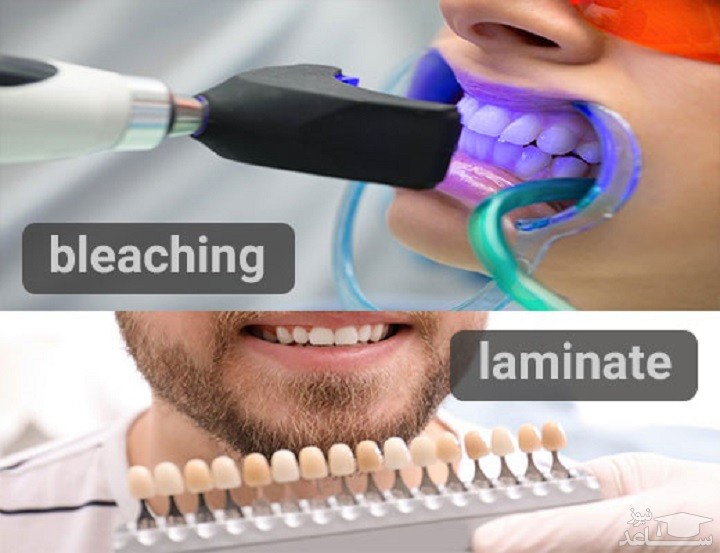 سفیدی دندان ها با بلیچینگ یا لمینت دندان: کدام بهتر است؟