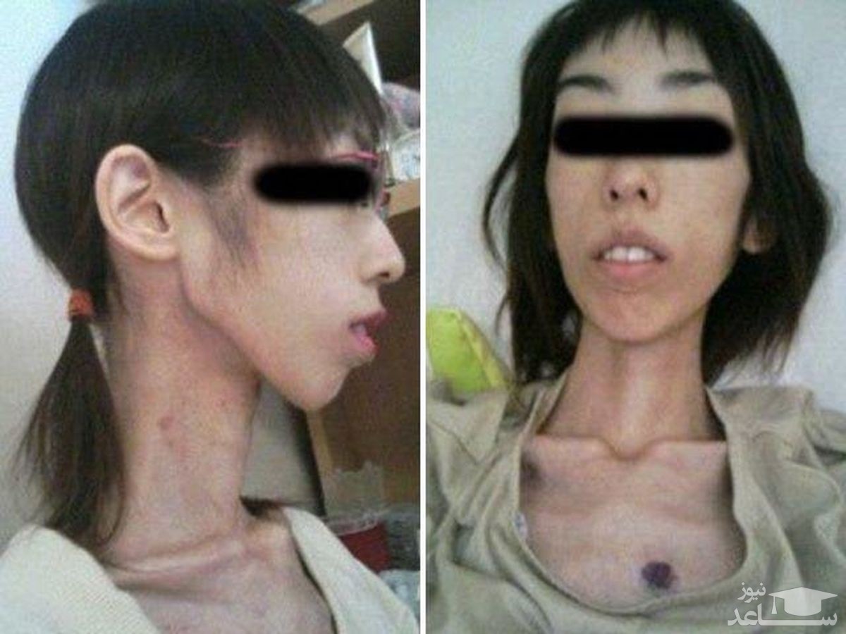 شکنجه عجیب دختر ژاپنی و کاهش وزن وی؛ دختر 20 ساله با وزن 17 کیلوگرم!