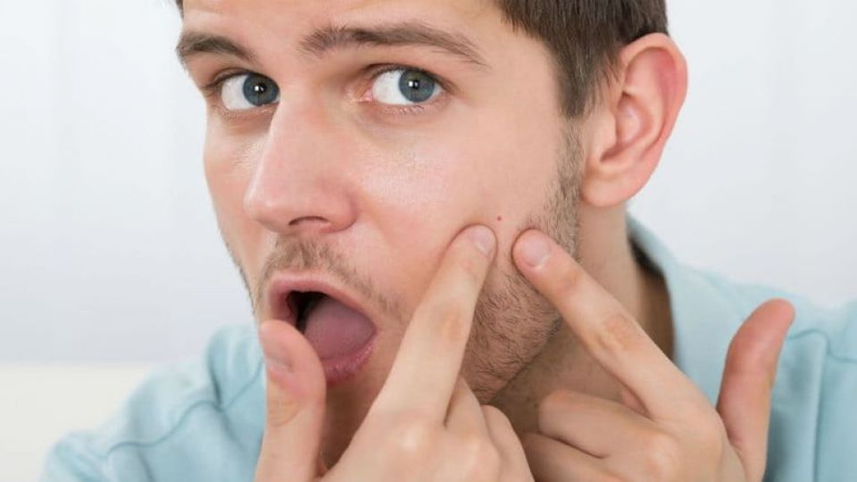 چگونه جوش‌های سرسیاه و سرسفید را از بین ببریم؟