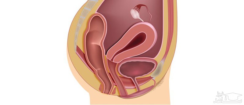 پرولاپس قدامی چیست و چه علائمی دارد؟