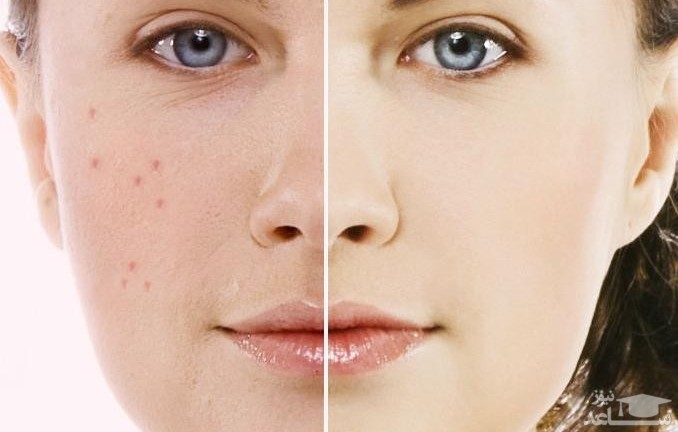 آنچه که باید در مورد جوش و آکنه بدانیم