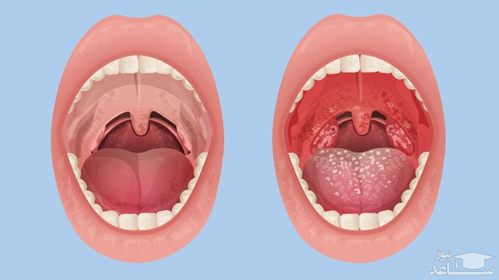 علت درد زبان چیست؟