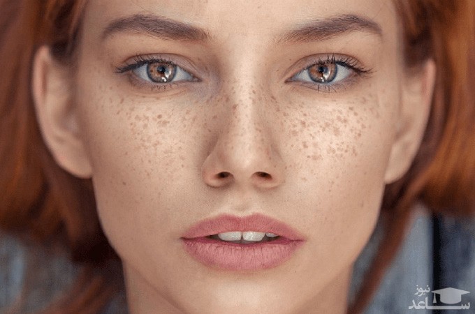 چگونه از شر کک و مک خلاص شویم؟