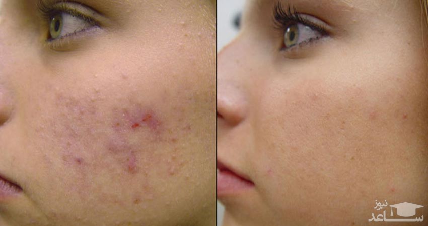 میکرونیدلینگ