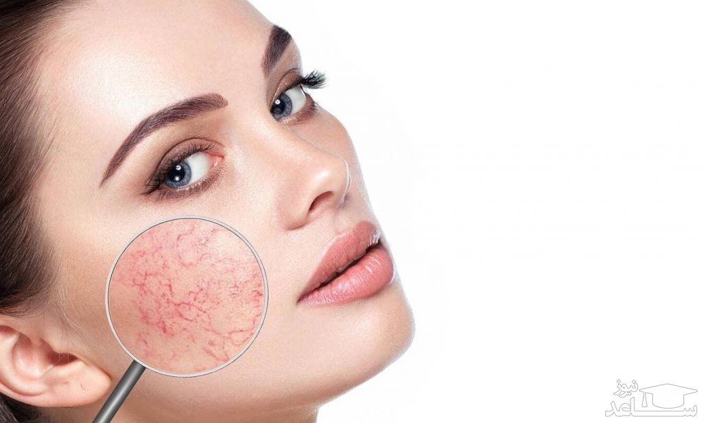 علت ایجاد رگ‌های عنکبوتی بر روی صورت و روش‌های درمان آن