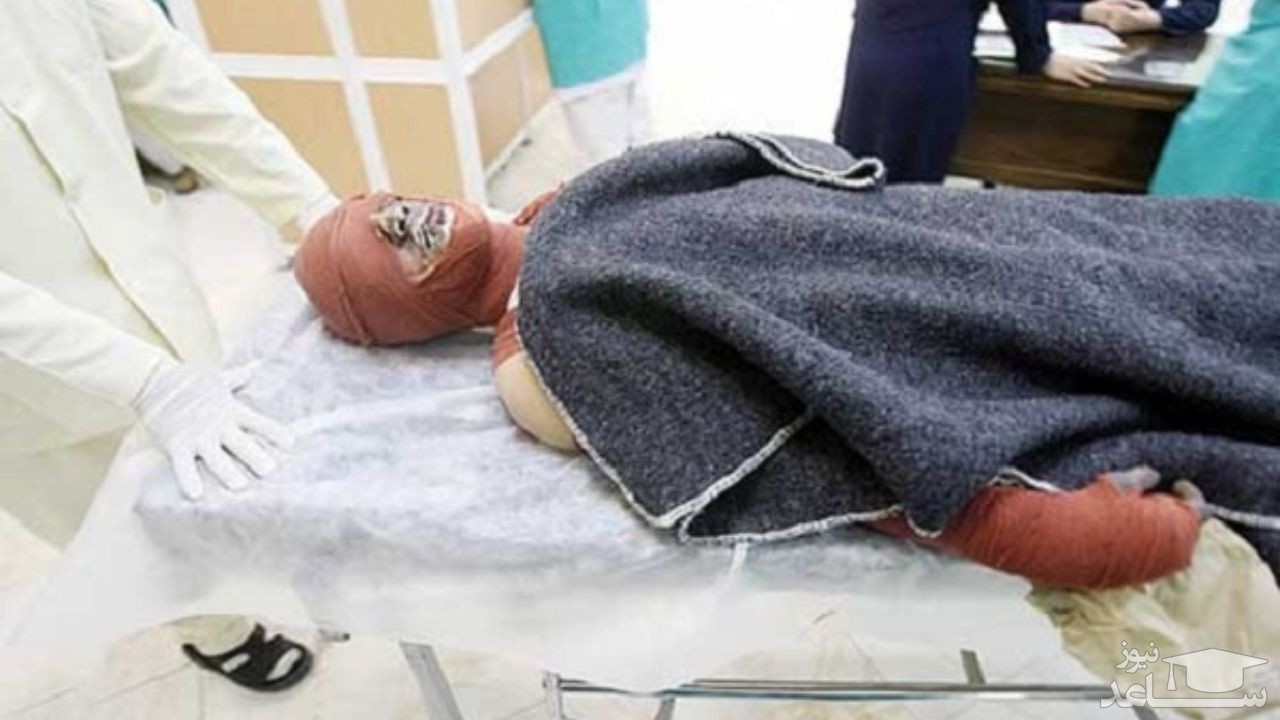 ۴۵ مورد مرگ ناشی از سوختگی در گیلان