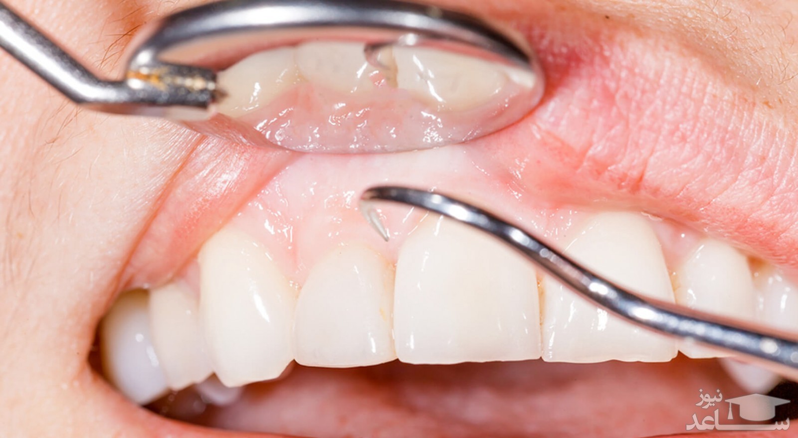 مراحل انجام ایمپلنت دندانی