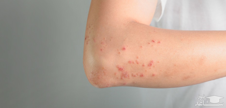 روش های درمان کهیرهای خارش دار در زنان باردار با طب سنتی