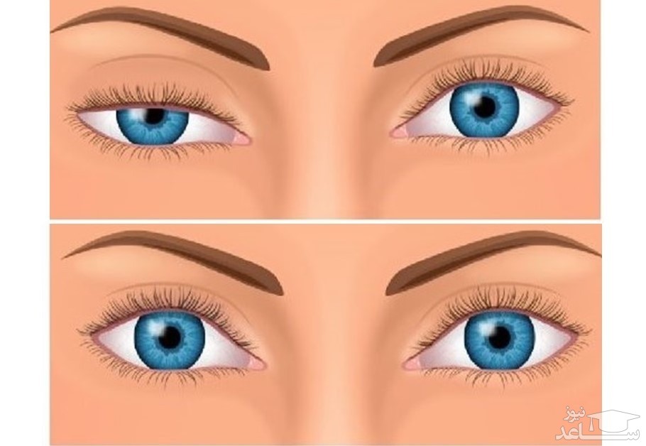 مقایسه پلک افتاده 