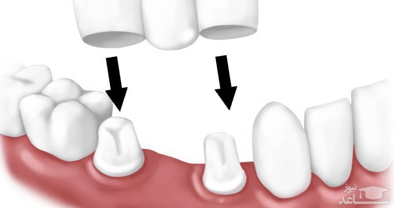 معایب و مزایا ی بریج دندان