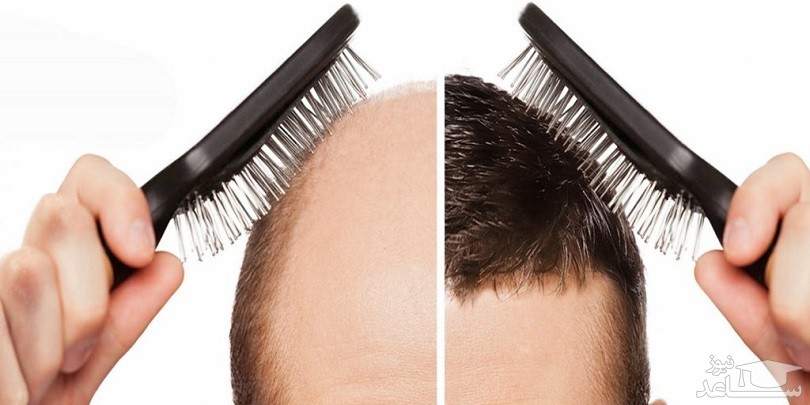 درمان ریزش مو در مردان به روش طب سنتی 