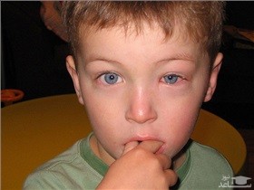 راهکارهایی برای درمان گل مژه در کودکان