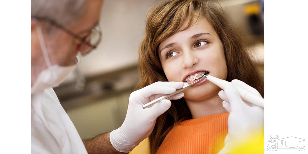 انواع بریس های دندان در ارتودنسی متحرک
