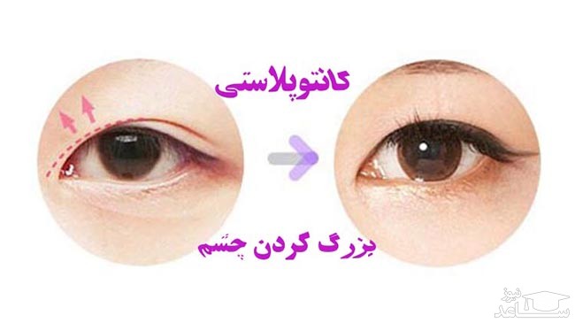 کانتوپلاستی