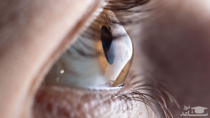 قرنیه مخروطی چیست ؟