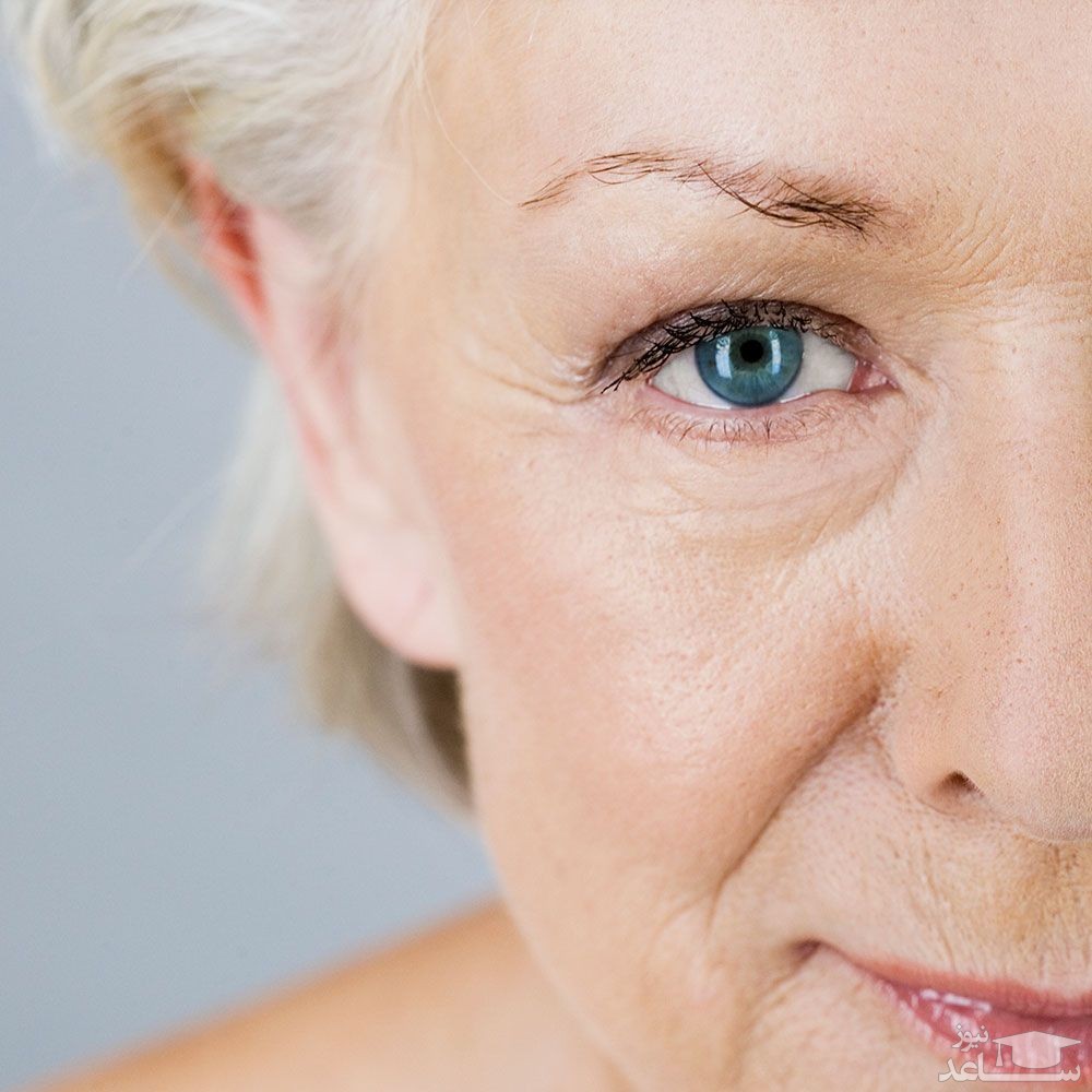 چروک زیر چشم و درمان های طبیعی آن