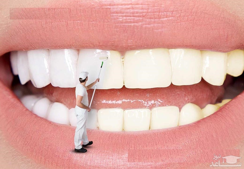 بهترین روش برای سفیدی دندان ها در طب سنتی