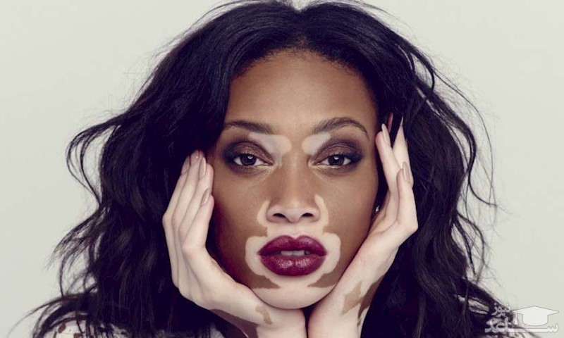 بیماری لک و پیس چگونه درمان می‌شود؟