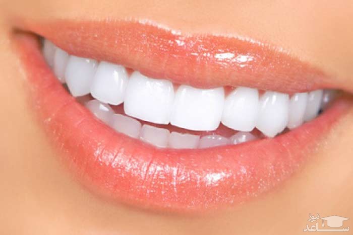 پوسیدگی دندان چیست؟