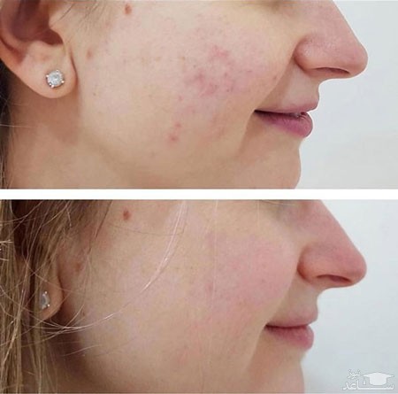 ترمیم کبودی صورت