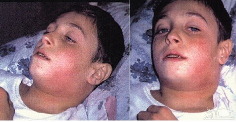 علل دیفتری و راههای درمان آن