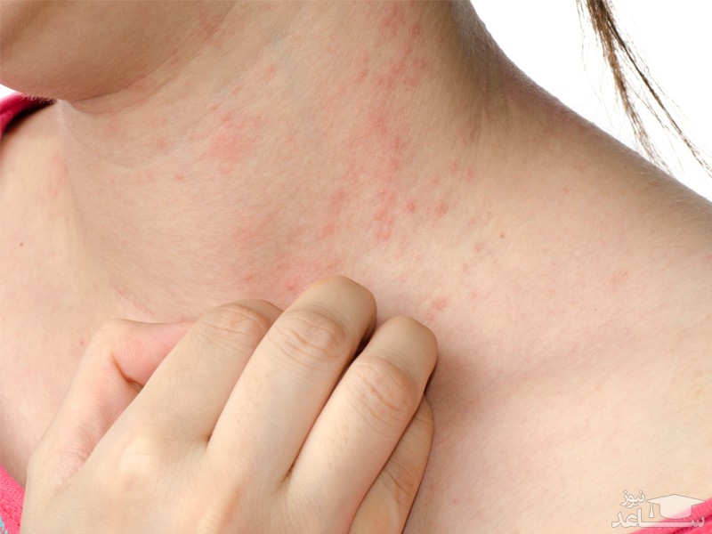 علائم پوستی از بروز چه بیماری هایی خبر می دهند؟