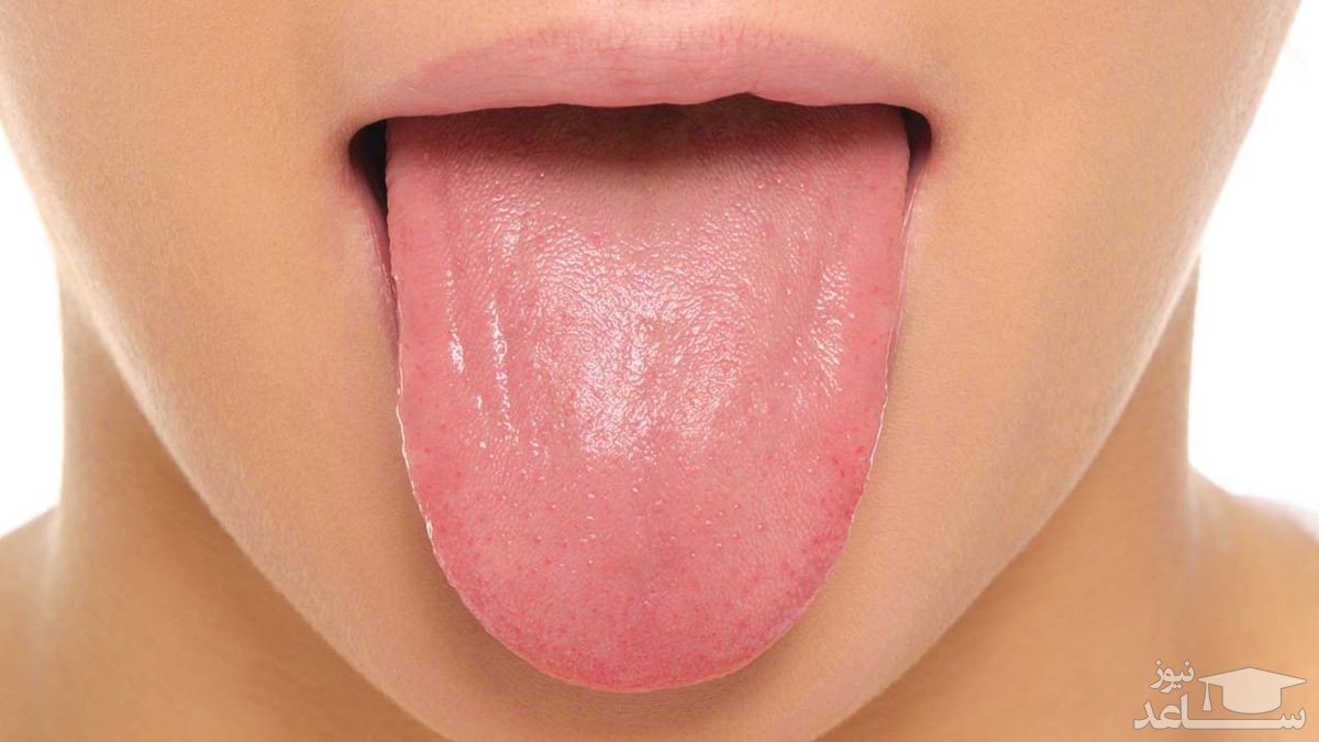 درمان سوزش زبان در طب سنتی