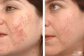 از بین بردن جای جوش و قرمزی پوست