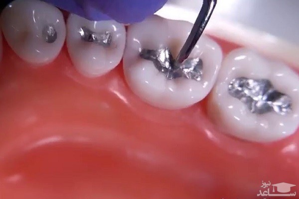 اگر قصد پر کردن دندان با آمالگام دارید، بخوانید