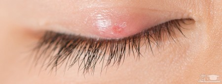 علائم گل مژه و راههای درمان آن