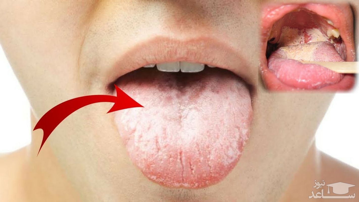 روش های تشخیص و درمان برفک دهان