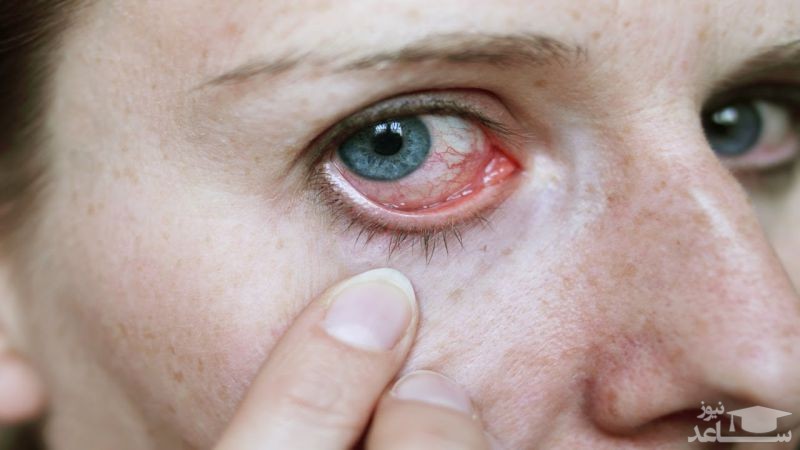 پوستر آسیب چشم ناشی از محصولات شوینده