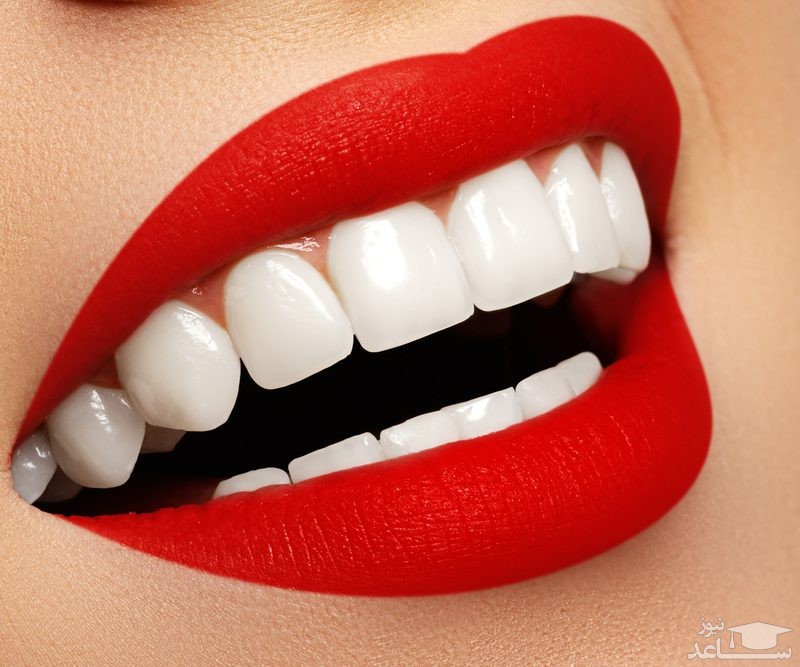 لمینت دندان چیست و برای چه افرادی مناسب است؟