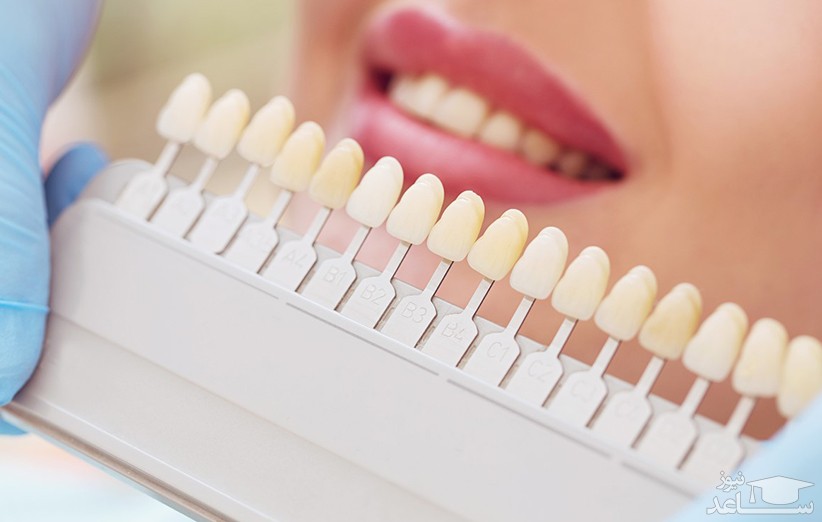 آمادگی های لازم برای ایمپلنت دندان چیست؟