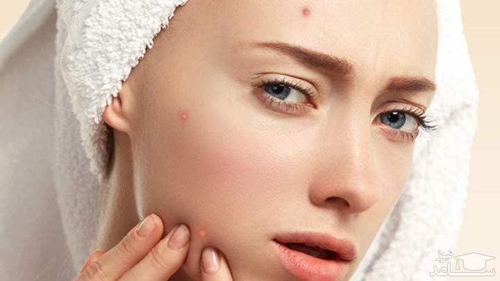 دلایلی برای جوش در بزرگسالی