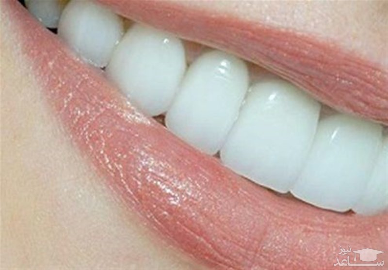 دندانپزشکی زیبایی شامل چه درمان‌هایی می‌شود؟