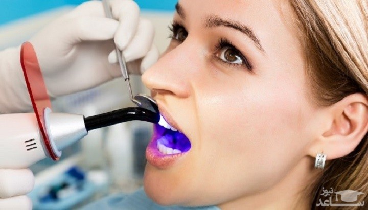 بررسی و مقایسه روکش دندان و کامپوزیت دندان: مزایا، معایب و هزینه