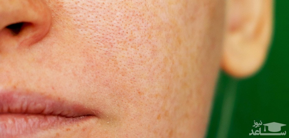 جلوگیری از تیره شدن پوست در زمان حاملگی