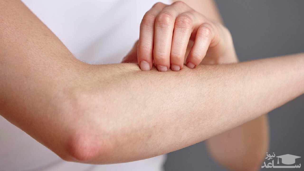 (عکس) بیماری عجیب پوستی به نام معجزه!